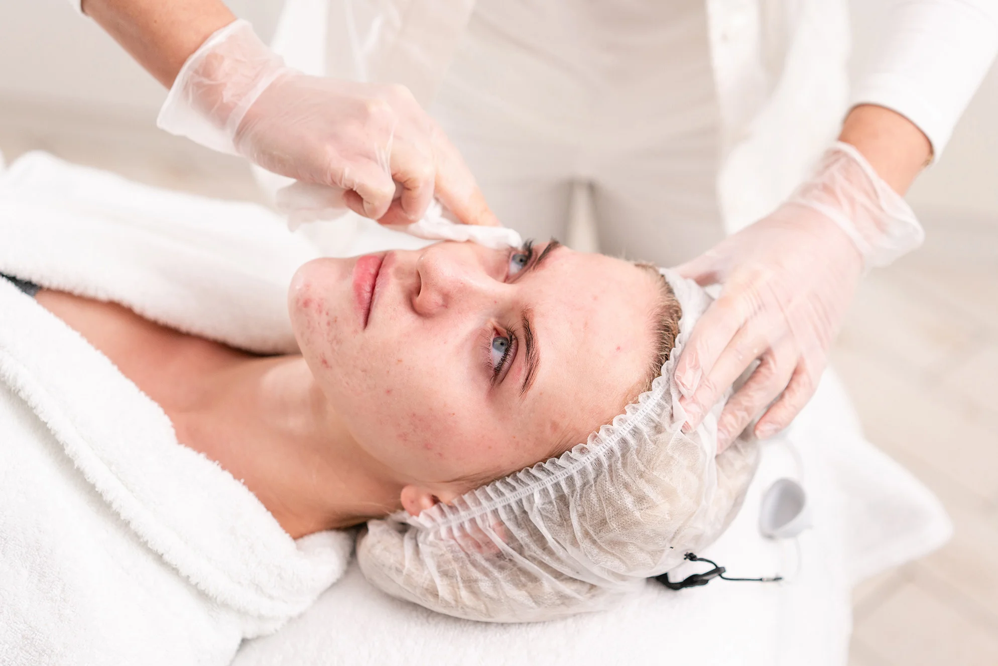 Female patient receiving active acne reduction treatment on her face.