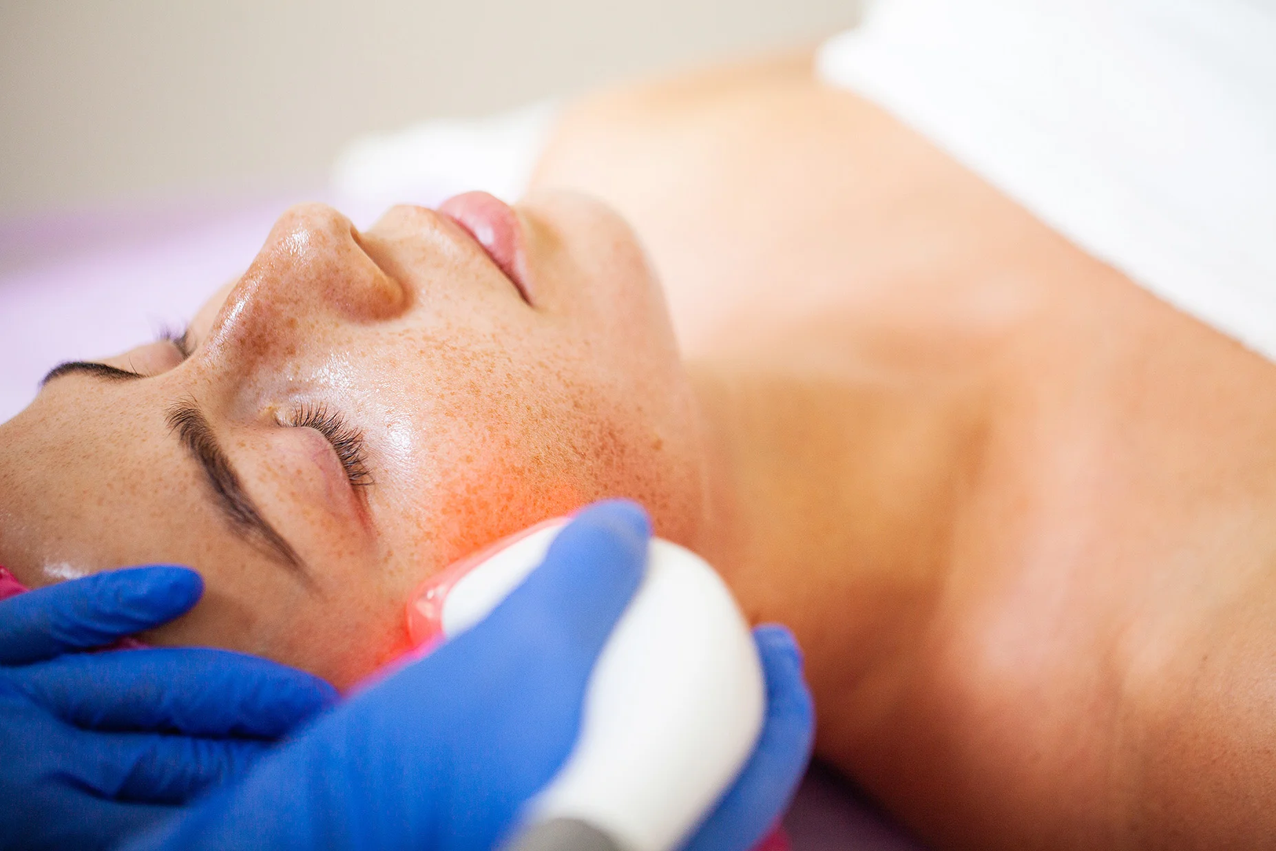 Female patient receiving age spots treatment on her face to reduce the appearance of sun spots.