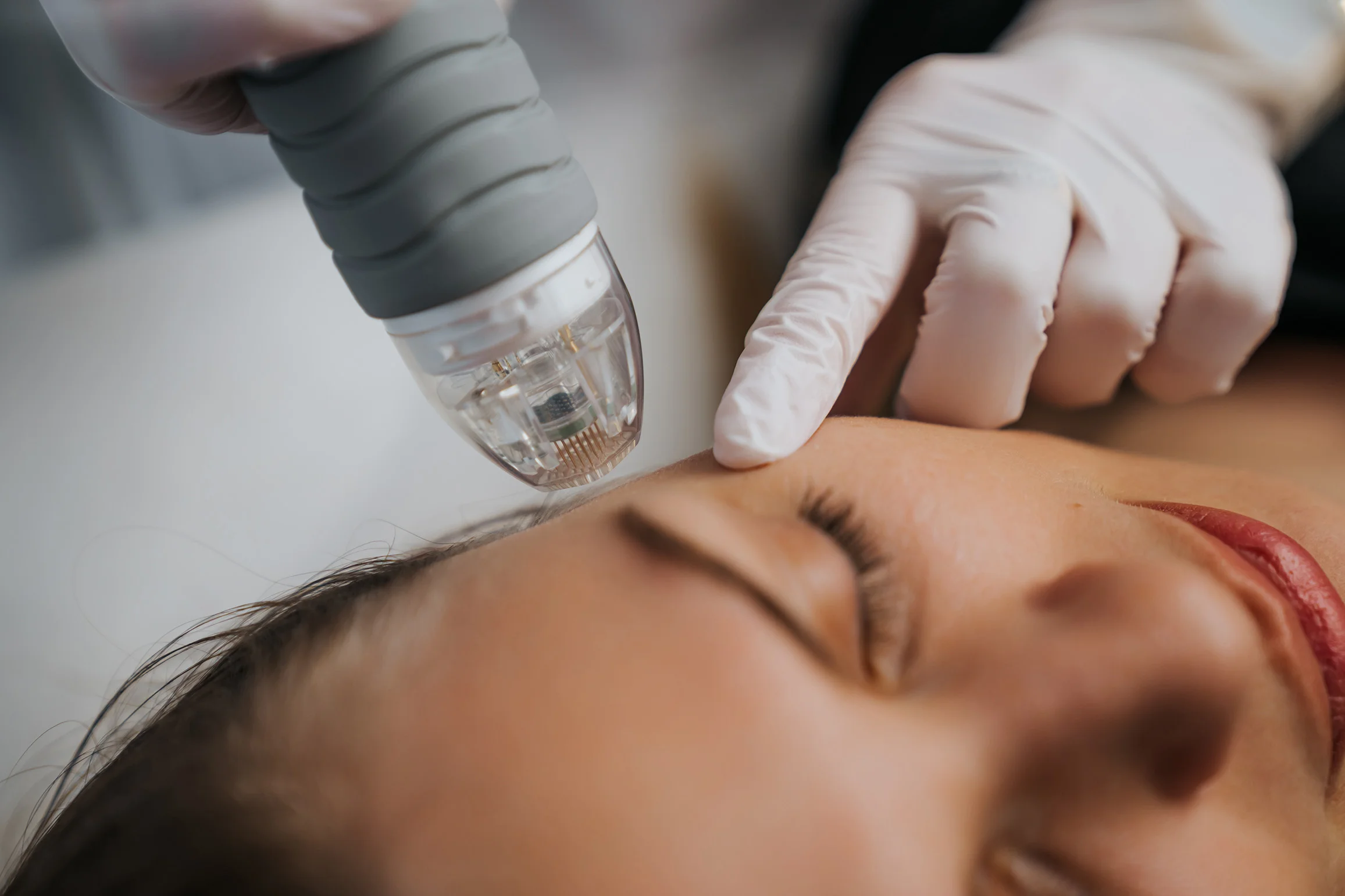 Female patient receiving microneedling treatment on her face for fine lines and wrinkles.