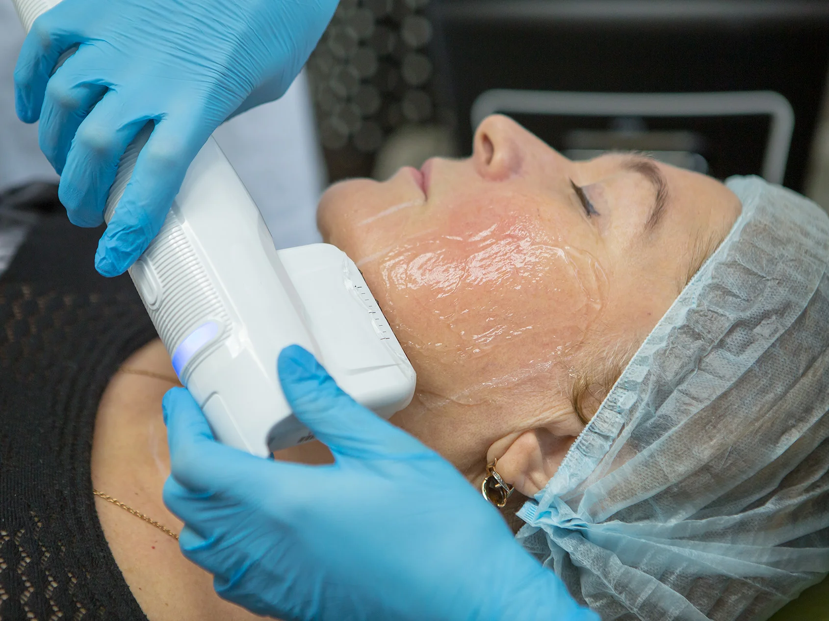 Middle-aged woman receiving skin tightening treatment on her face.