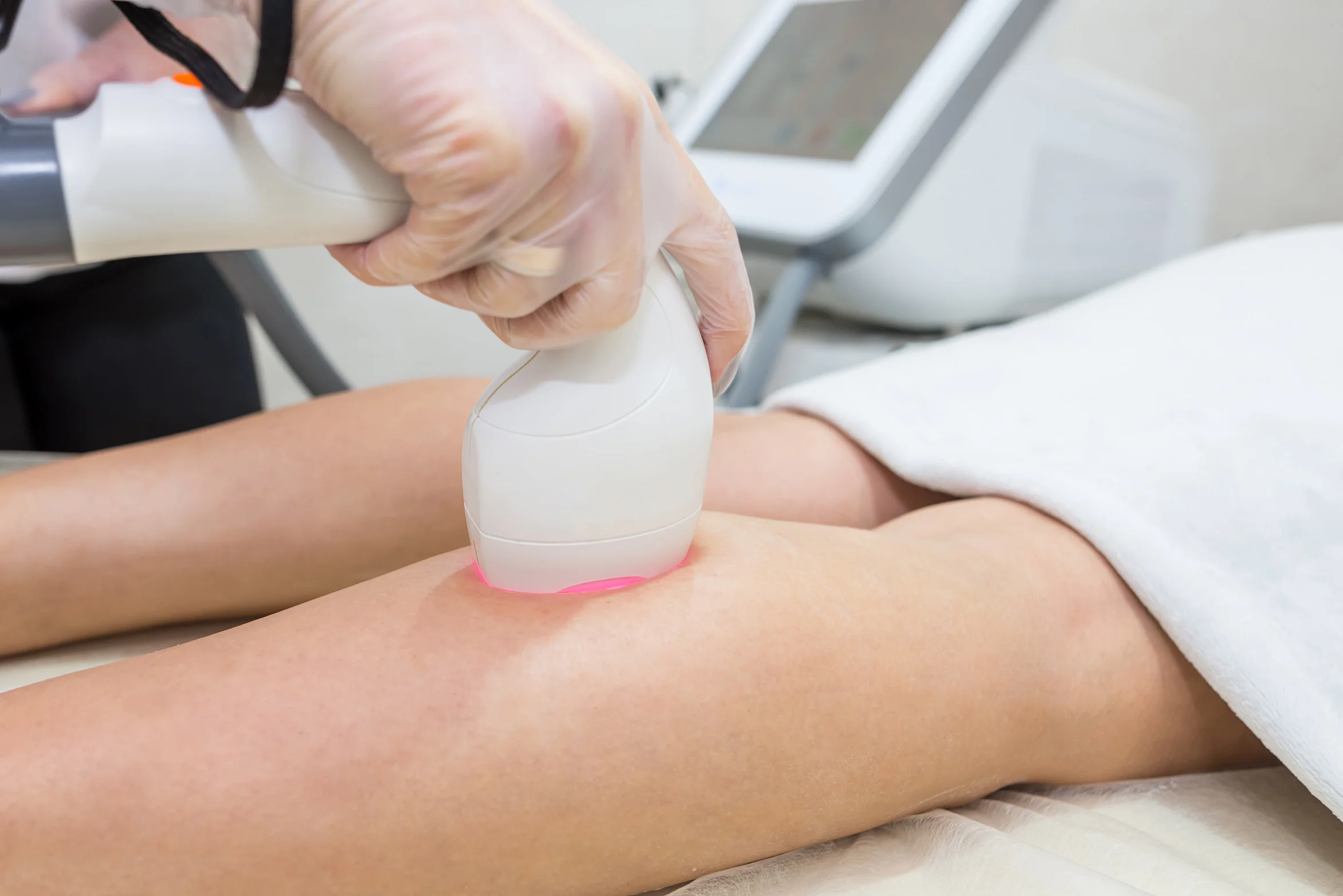 Female patient receiving spider vein treatment on the back of her calves.