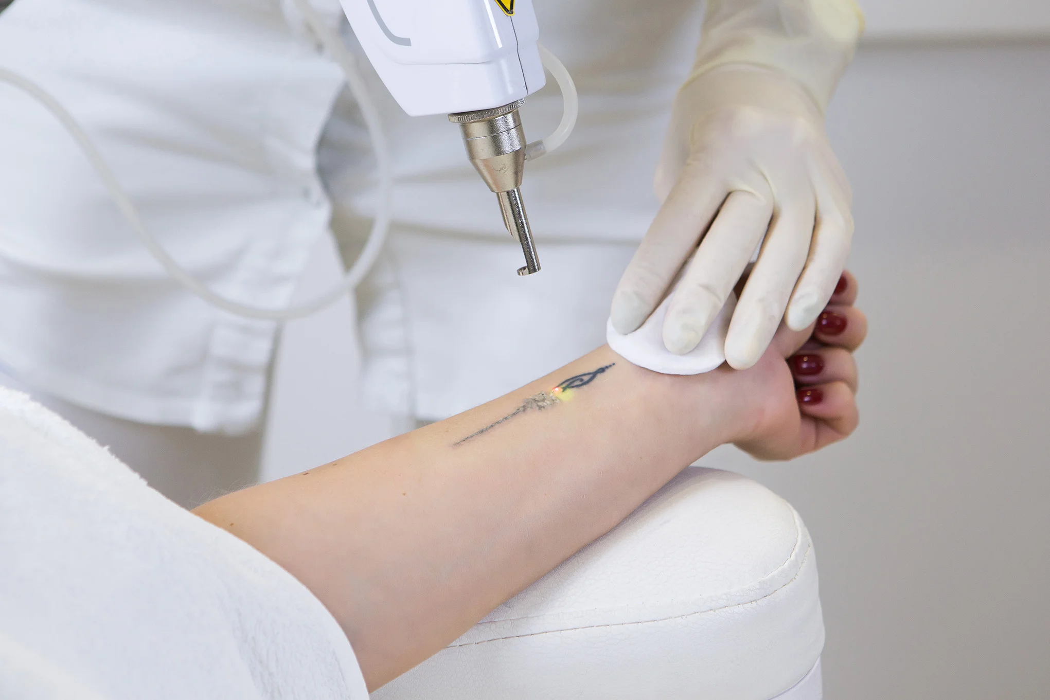 Close-up of a woman’s forearm receiving laser tattoo removal treatment on a forearm tattoo.